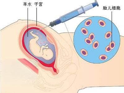 羊水穿刺亲子鉴定详解：原理、准确性及潜在风险