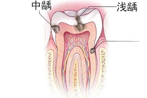 从龋齿到龋洞：如何及时发现并采取有效治疗措施