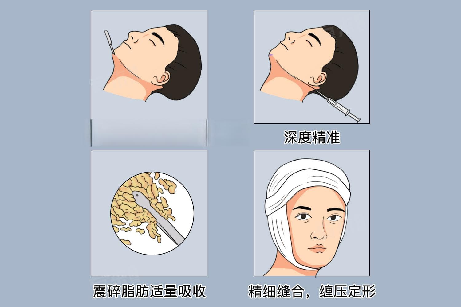 吸脂手术全过程详解：从术前准备到术后护理