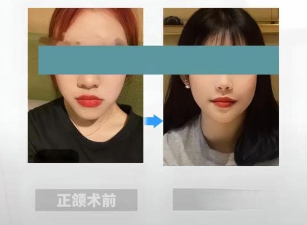 正颌与正畸联合诊疗的重要性