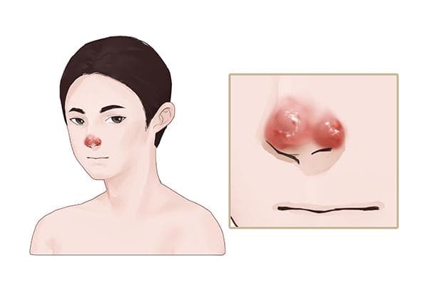 鼻子长白毛是什么征兆