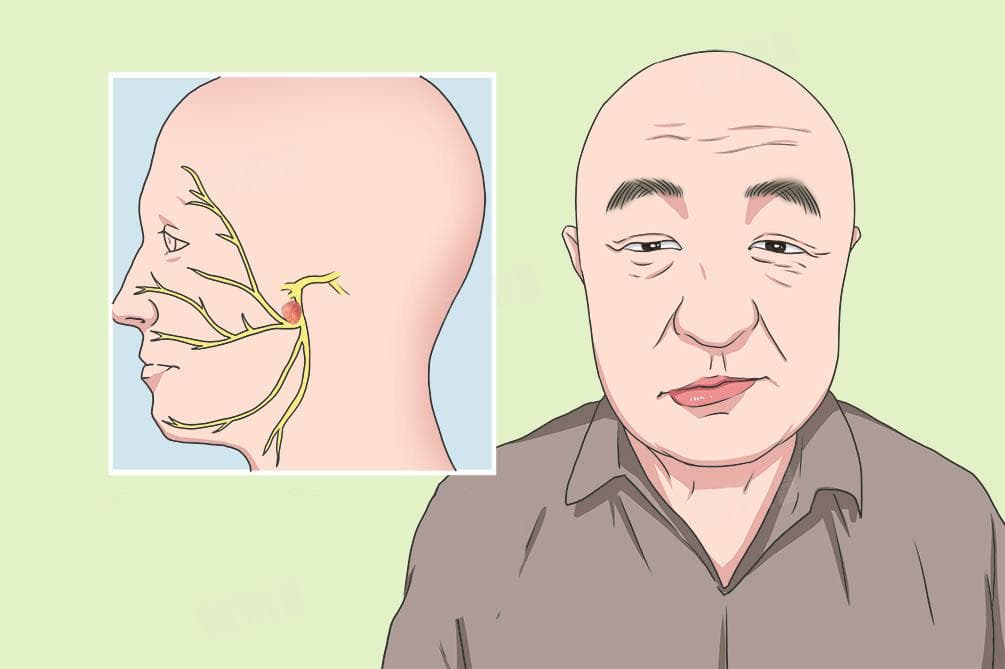 脸部抽搐跳动的原因及应对方法