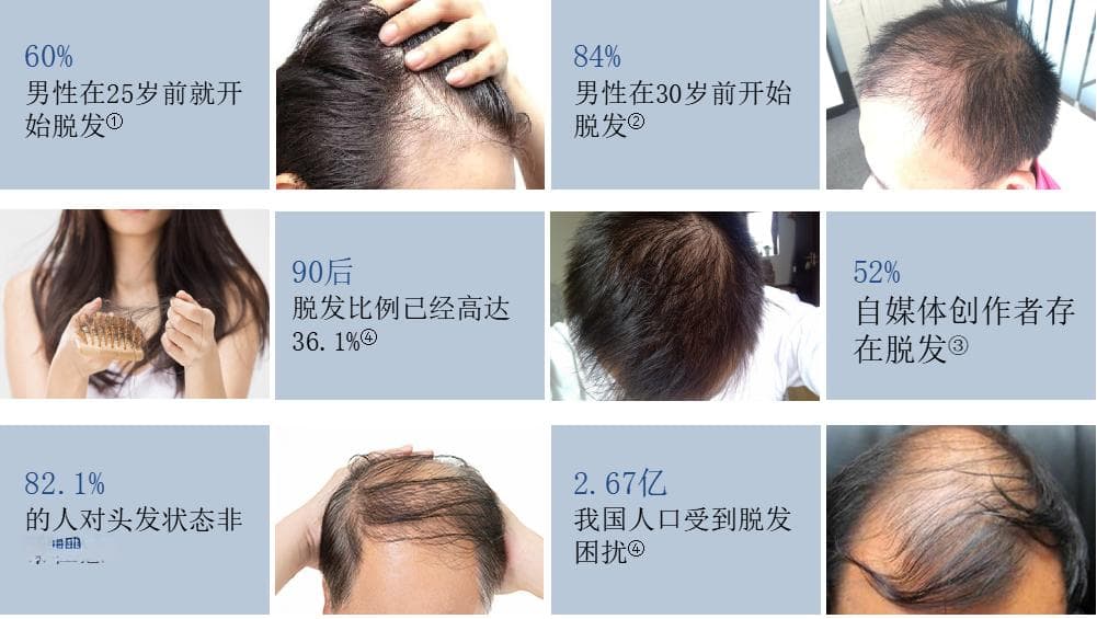 自体毛囊生发毛囊细胞移植促进脱发再生