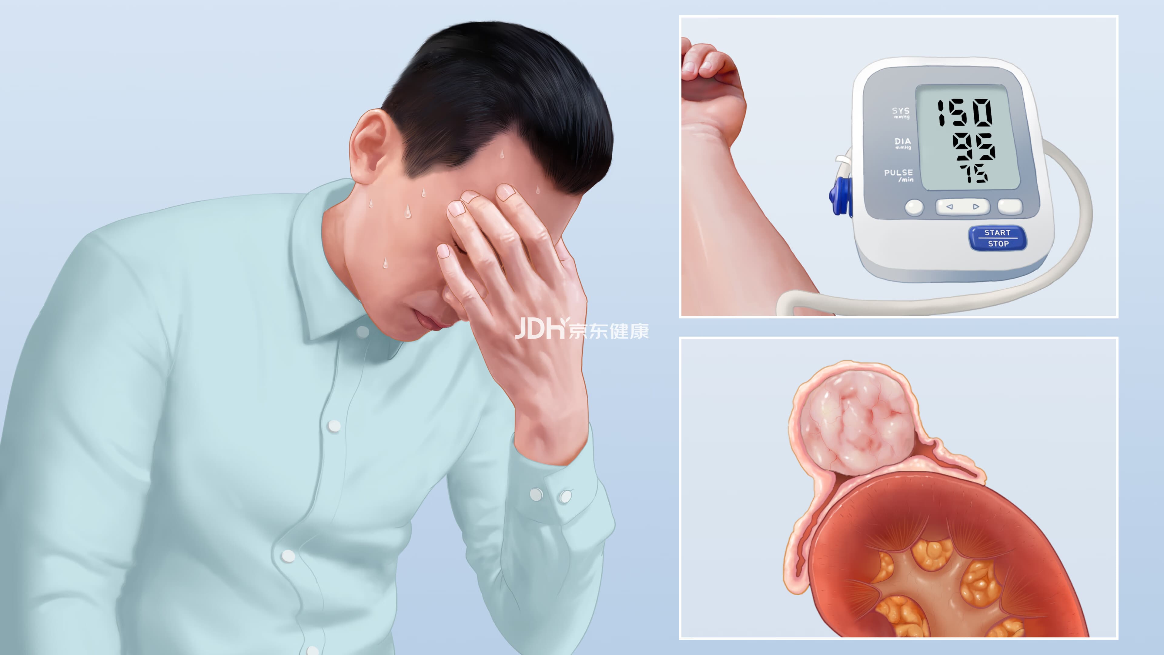 嗜铬细胞瘤：症状、诊断与治疗全解析