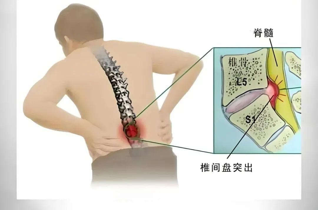 最新研究：手术能显著改善腰突患者的腰痛症状，但女性术后腰痛缓解面临更大挑战