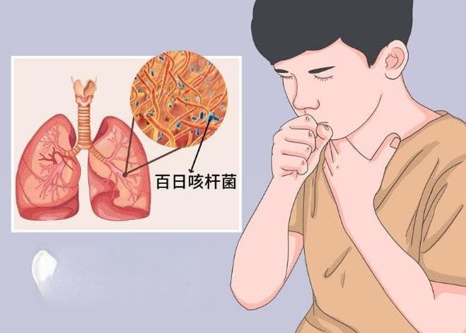 百日咳再现，新一代疫苗研发进展如何？