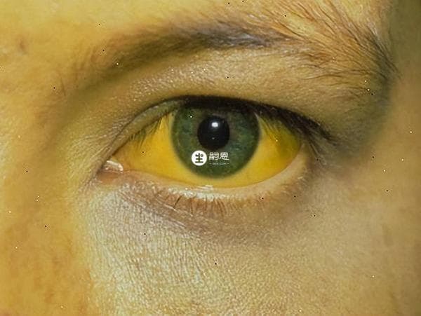黄疸：症状、病因、危害及处理方法全解析