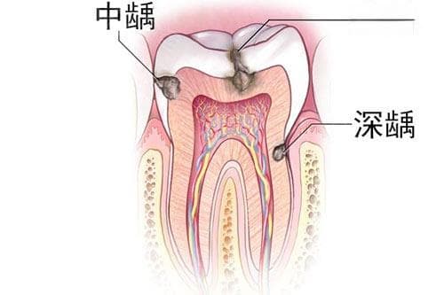 后牙黑黑的那种是虫牙吗？有龋齿要怎么处理