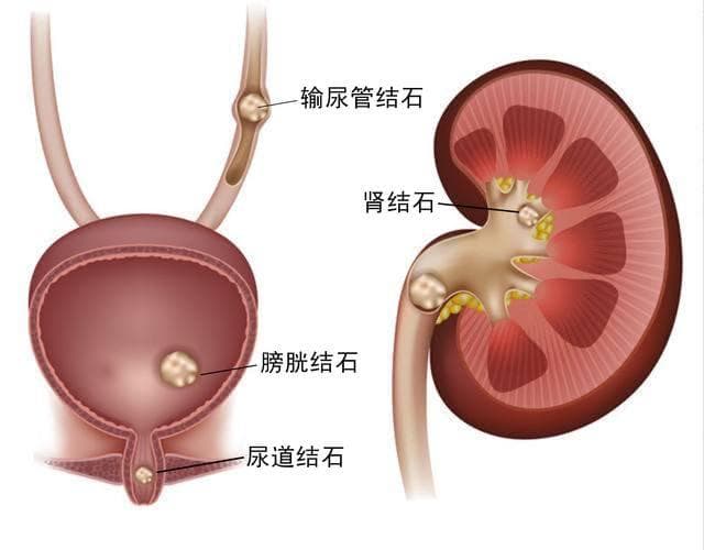 5mm以下光滑结石可自排，但这些情况需谨慎