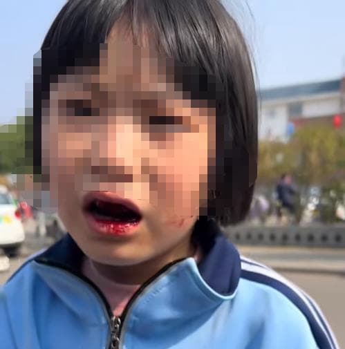 女童哭诉被7名同学打得满嘴血，父亲称不追究责任，律师：需考虑女童和其他监护人意见