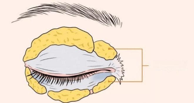 整形医生张耐洋：肿泡眼的全面解析与改善方法