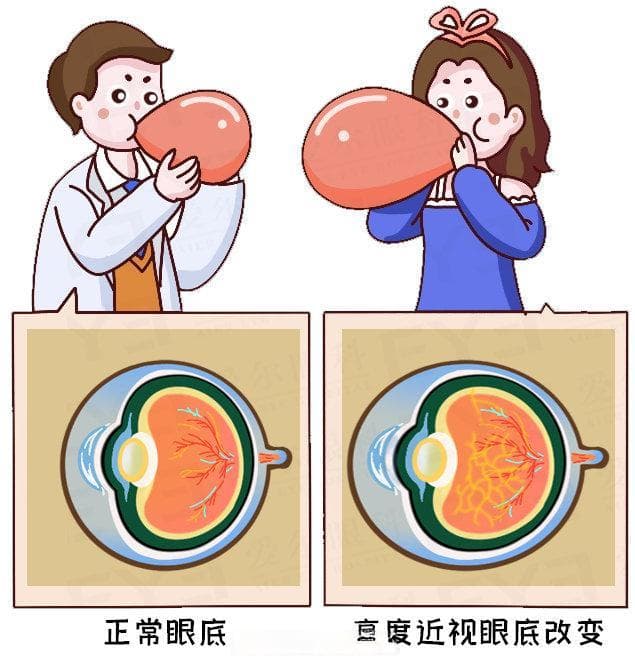 不能顺产？不能蹦极？给600度以上近视星人的小建议