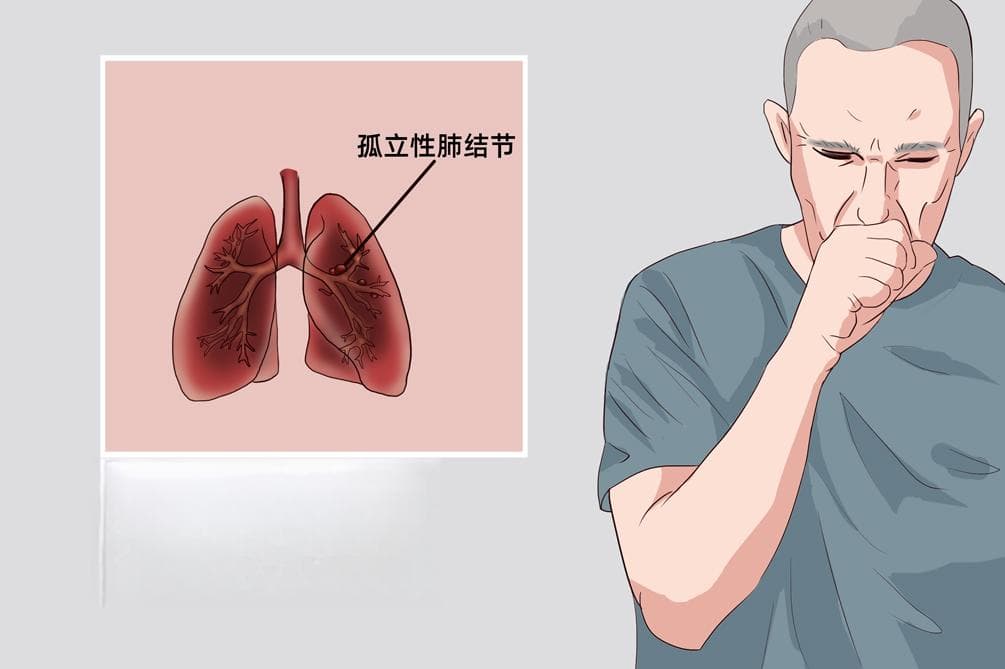 孤立性肺结节