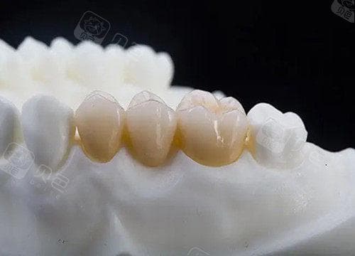 一般假牙装上去要多久适应?固定假牙三月搞定,普通假牙则需六个月