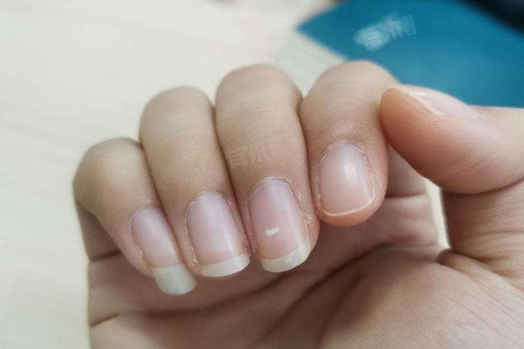 指甲出现白点是什么原因
