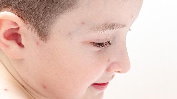 春季幼儿皮肤红斑频发？3大常见病因及家长应对指南