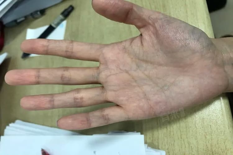手掌青筋突然很明显是为什么