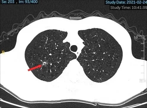 一例复杂性多原发肺癌的多学科MDT局部+全身综合治疗获得长生存