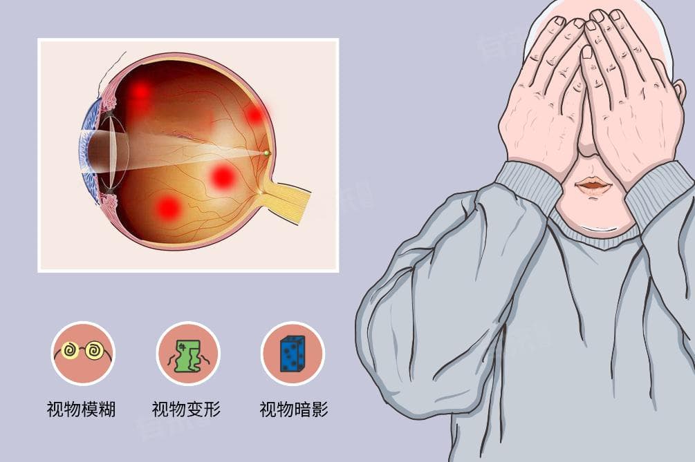 眼底水肿是怎么回事？可能由这些原因造成