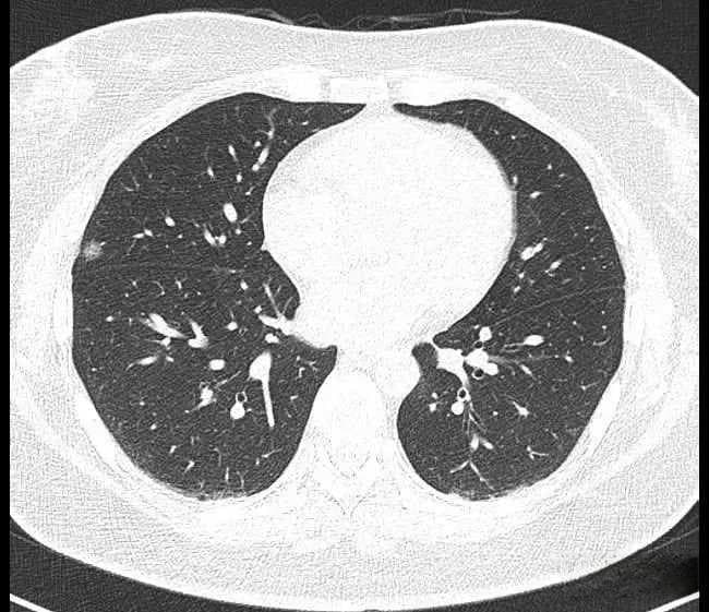 检出率高、辐射量低的低剂量螺旋CT，哪些人群需要做？