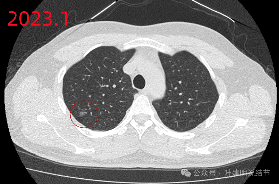 专家解读：肺结节消融还是手术？一文读懂诊断与治疗关键