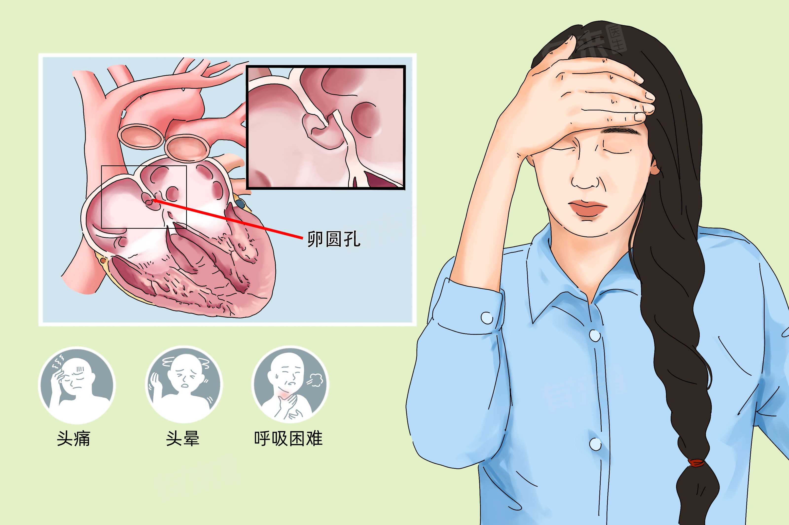 卵圆孔未闭合对身体的影响
