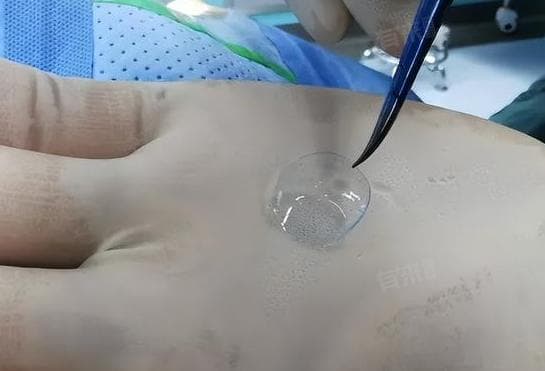 绷带镜的作用和注意事项