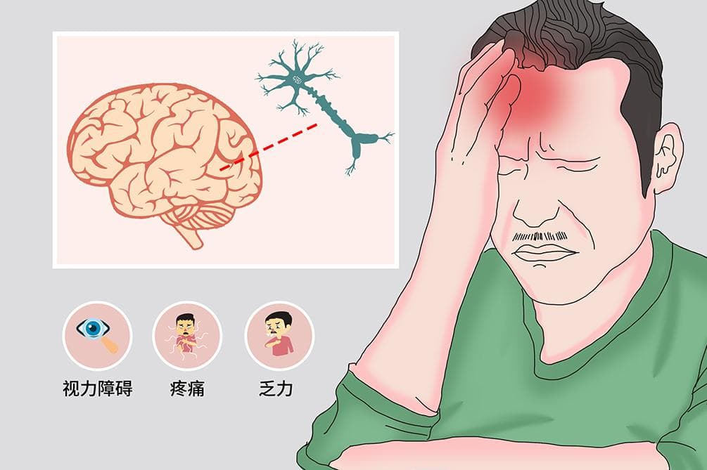 多发性硬化症