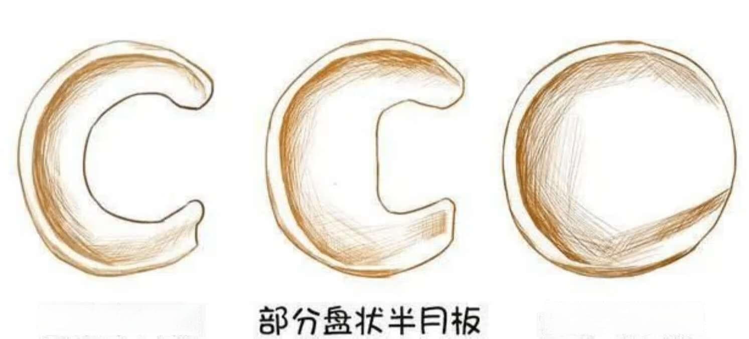 关于先天性盘状半月板，你知道吗？