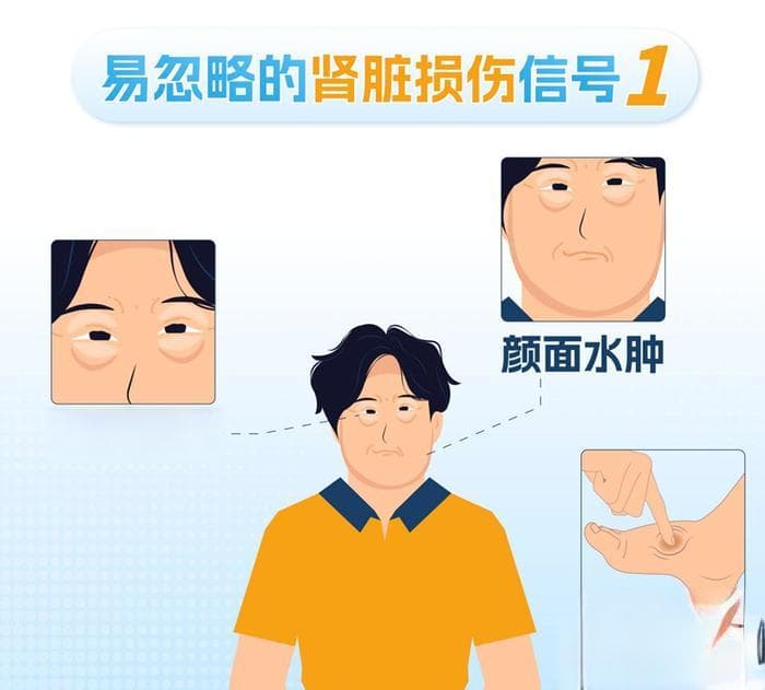肾内科：教您如何自测肾功能，不要让肾病演变成尿毒症！