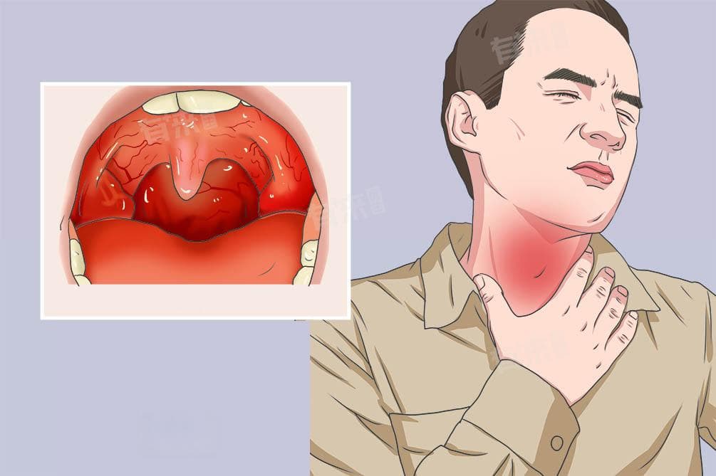 嗓子发炎吃头孢克肟还是克洛