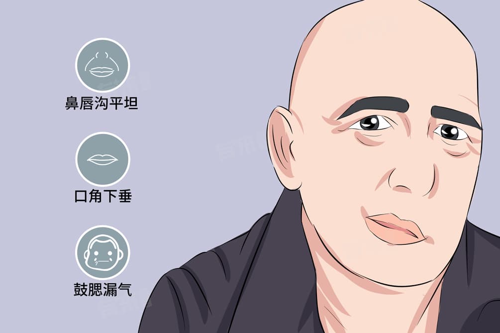 面神经炎症状表现有哪些