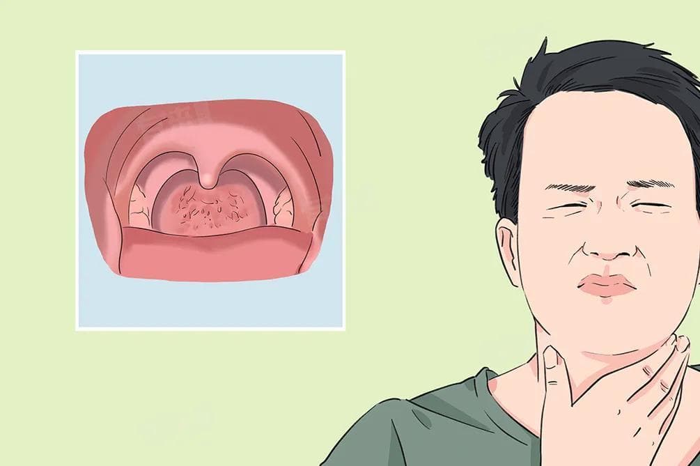 慢性咽炎反复发作怎么治疗