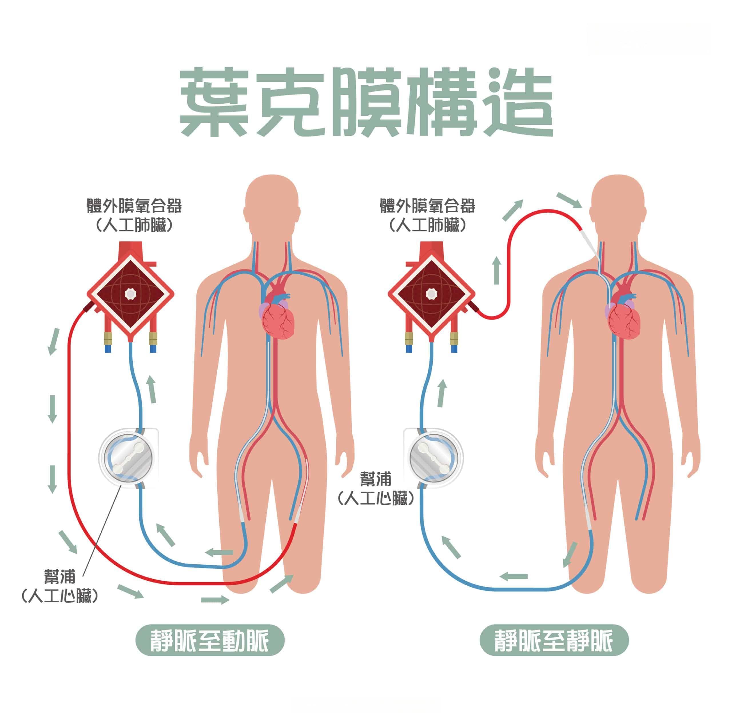 叶克膜是什么？ECMO的原理、用途、风险、费用