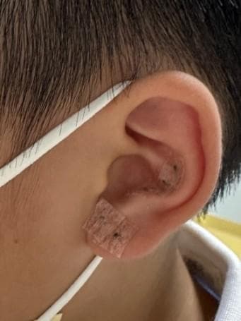助推儿童近视防控等眼病防治的有效途径——中医适宜技术