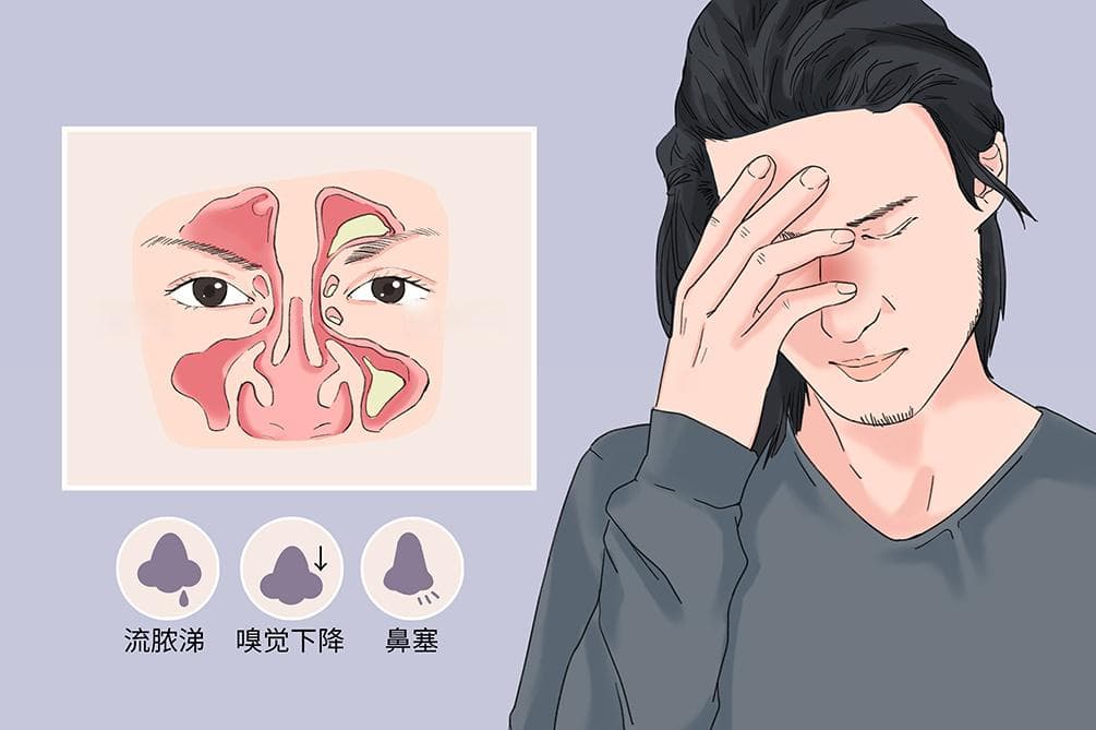 鼻窦炎疼痛难忍怎么办