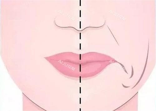 一文解释清楚什么叫口角囊袋？口角囊袋是怎么形成的？口角囊袋应该怎么去除？