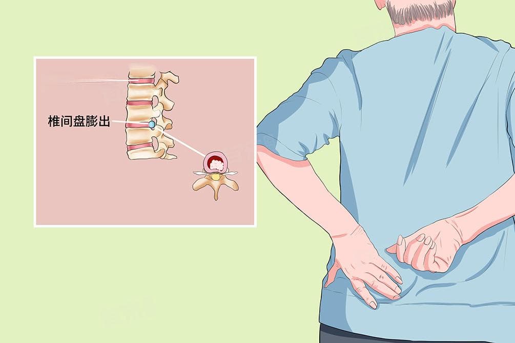 腰椎盘膨出是什么意思