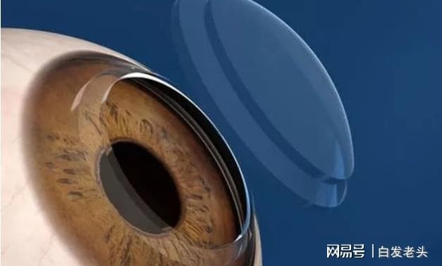 OK镜真的能治好近视吗？