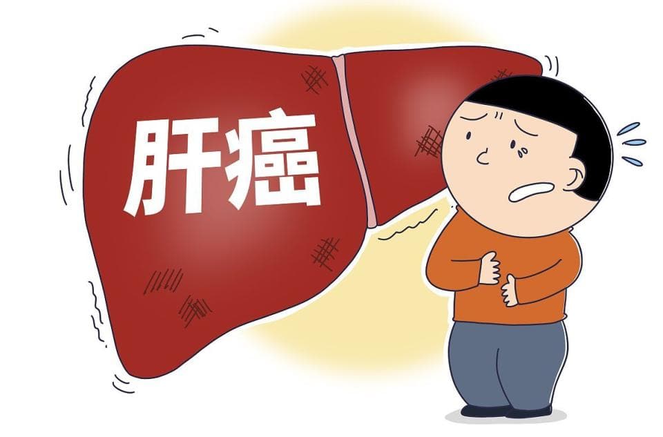 甲胎蛋白升高一定是肝癌吗？不一定，但要及时做好这些筛查！