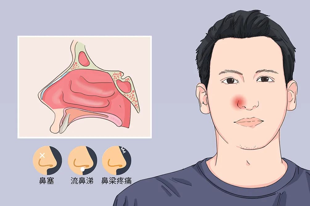 鼻甲肥大的症状及危害