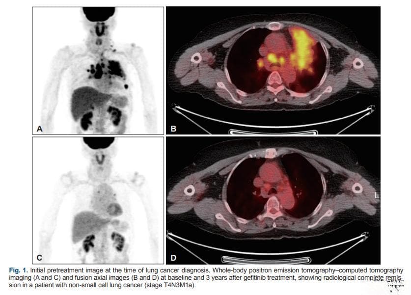 EGFR 19del非小细胞肺癌硬脑膜转移患者获益奥希替尼，实现完全缓解