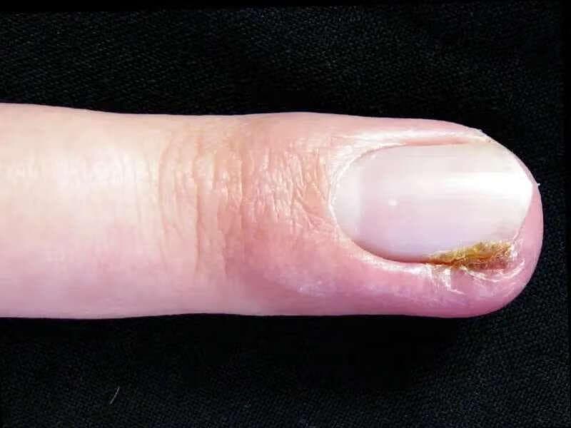 甲沟炎最全面的治疗