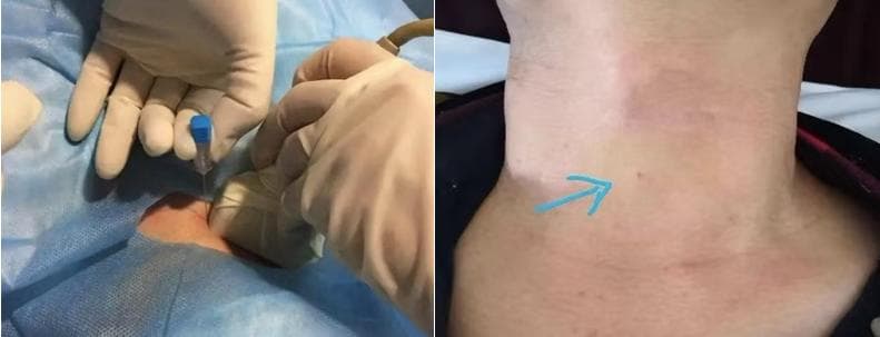 超声引导下甲状腺结节穿刺活检术：原理、优势与风险全解析