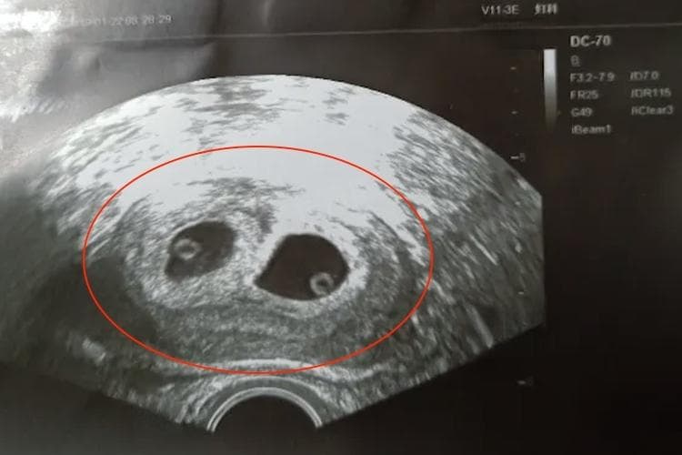 双胞胎是一个受精卵还是两个受精卵