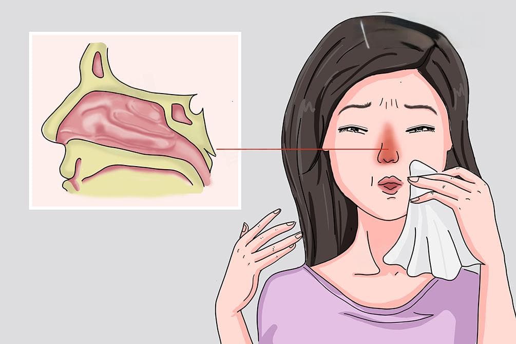 一文读懂鼻炎和鼻窦炎：症状区别与检查方法
