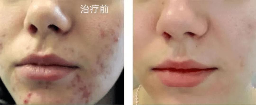 健康科普 | 肌肤“小陷阱”——痘坑