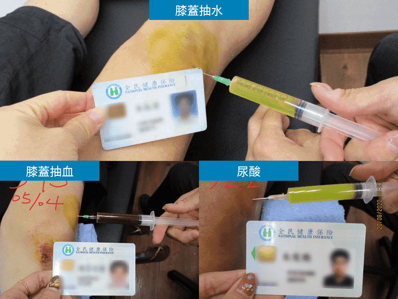 膝盖积水怎么办？原因、症状与治疗方法全解析