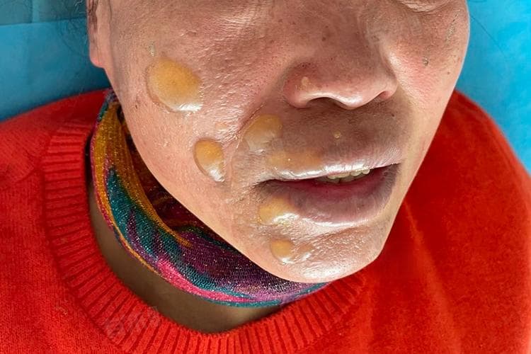 烧伤起泡用什么覆盖在水泡上