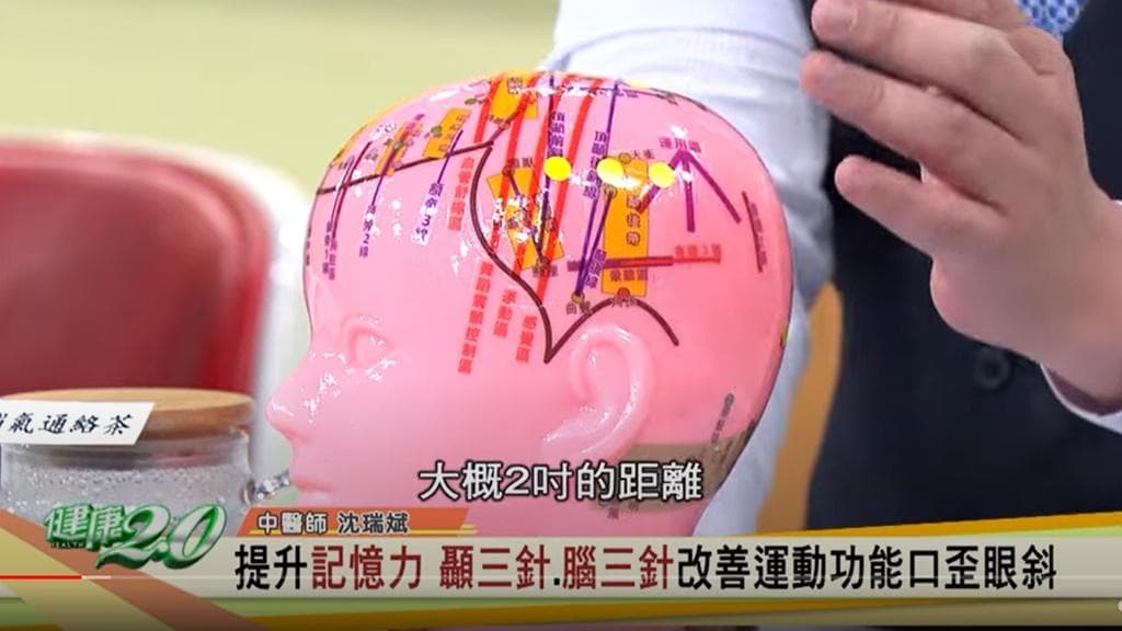 老了最怕忘东忘西、视力差！颞三针与脑三针治中风后遗症 强记忆力护视力